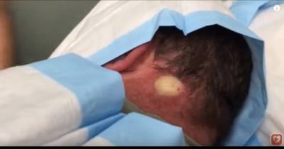 Infected Cyst On Man's Neck Explodes With Sickening Blood And Pus!