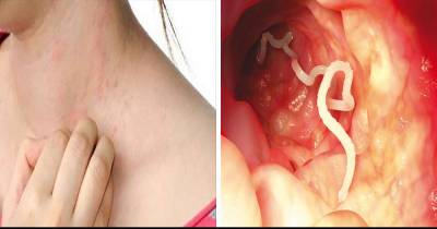 10 Warning Signs That Your Body Is Full Of Parasites