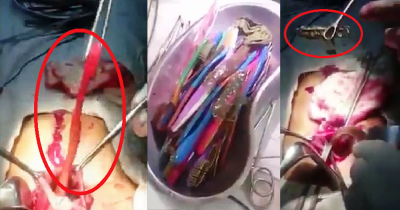 Bizarre Moment Surgeon Pulls Out 18 Toothbrushes From Patient's Stomach