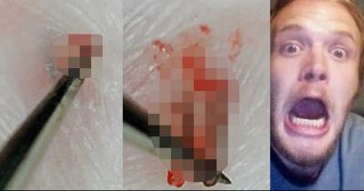 Picking Out The Longest Most Disgusting Ingrown Hair Will Make You Want To Turn Away