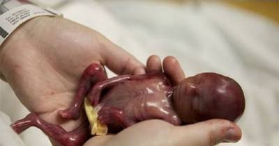 Most Tragic Abortion Stories That Will Break Your Heart