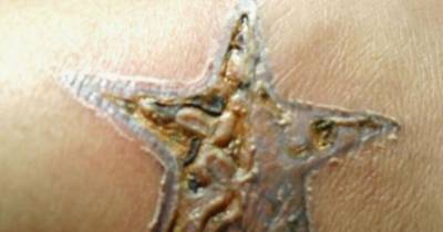 How To Treat An Infected Tattoo, Signs, Symptoms And Care!