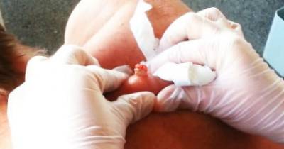 Man Gets 30 Year Old Cyst Exploded Off Of Back