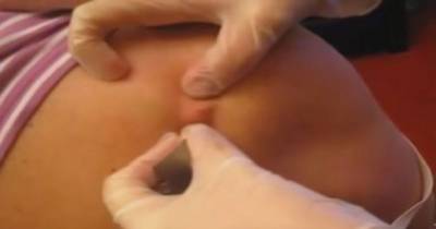 Sisters' Have Hilarious Reaction As They Squeeze Mum's Enormous Back Cyst