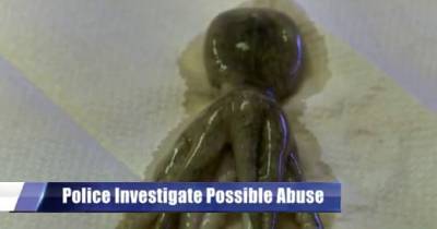 Octopus Removed From 2-Year-Old&rsquo;s Throat; Child Abuse Charges Filed