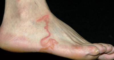 Doctor Thought It Was A Varicose Vein But When He Looked Closer... Weird!