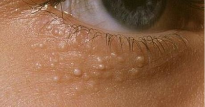 This Is What Those Weird Small White Dots On Your Face Mean. BEWARE!