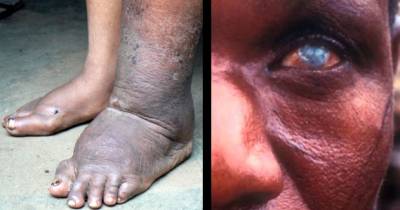 The Nastiest Parasites In The World