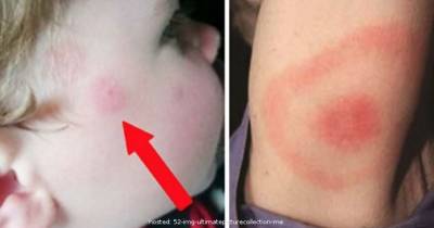 If You Ever See A Mark Like This On Your Child, Take Them To The ER, Here's Why.