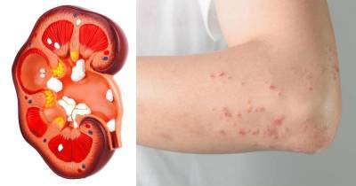 Sure Symptoms Of Kidney Stones