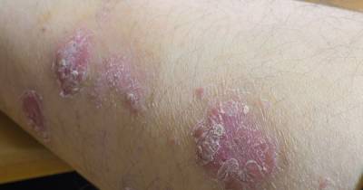 8 Weird Skin Diseases That Show Your Health Is At Risk!