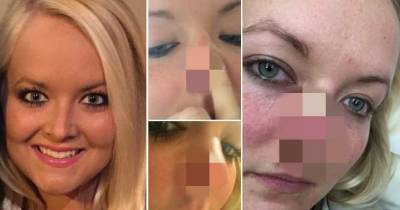 Nurse Who Began Using Sunbeds Aged 13 Reveals Coin-Shaped HOLE Surgeons Cut Out Of Her Nose After She Developed Skin Cancer