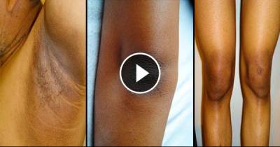 9 Surprising Ways To Naturally Brightup Dark Underarms, Knees & Elbows