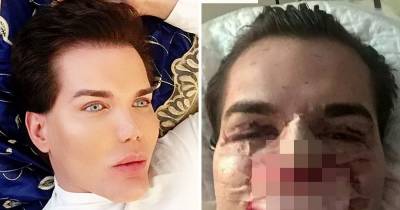 Plastic Surgery Addict Rushed To Hospital After Nose Starts To Rot