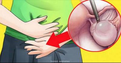 Warnings Of Ovarian Cyst Every Woman Should Know