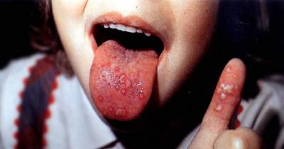 Near Deadly Diseases You Can Catch From Kissing