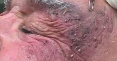 Dr Pimple Popper Is Back With Another Graphic Video