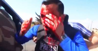 Reporter Bloodied After Being Hit With Shrapnel On Live TV