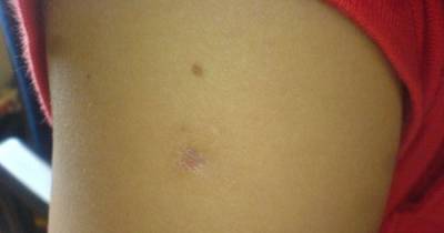 Ever Wondered What This Nickel-Sized Scar On Your Upper Left Arm Means? This Is The Answer
