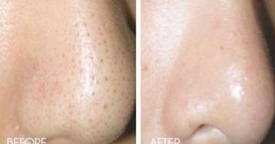 How To Get Rid Of Large Pores Permanently