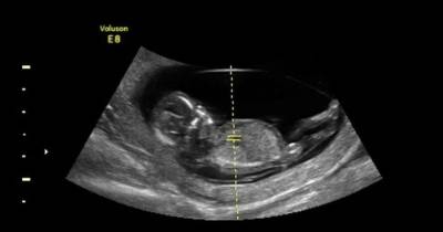 Surrogate Refused To Abort Baby Despite Diagnosis. 3 Years Later, The Consequences Are Crystal Clear
