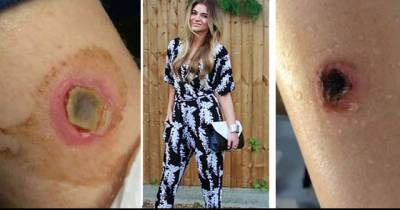 A Painful Bubble Appeared On Her Skin And Started To Grow