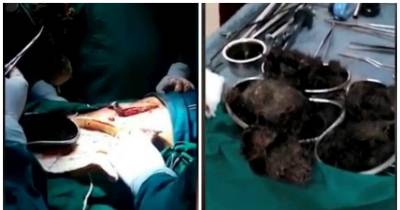 Doctors Remove HUGE 2.2lb Hairball From Teen's Stomach - As She Can't Stop Chewing Her Hair