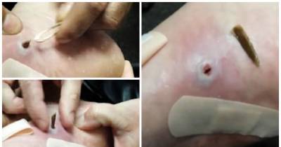 Is This The Biggest Splinter You've Ever Seen? Watch The Moment An Inch-Long Shard Of Wood Is Yanked From Man's Foot