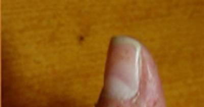 If You Bite Off The Skin Around Your Fingernails, You Need To Stop. Here&rsquo;s Why.