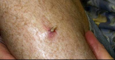 Parasitic Infections You Wouldn&rsquo;t Wish On Your Worst Enemy