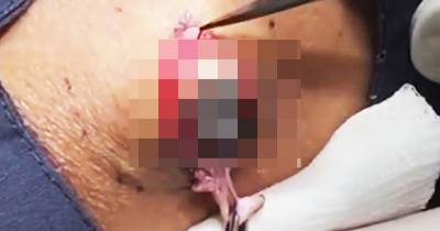 Golf Ball Sized Cyst Gruesomely Exploded By Dr. Pimple Popper