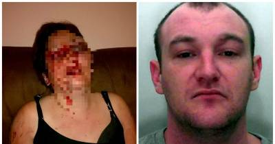 Pictured: Horrible Injuries Of Mum Battered By Partner In Front Of Their Child Because He Thought She Was Texting Other Men
