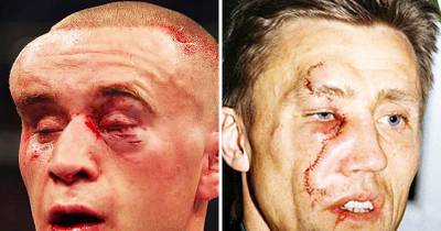 12 Of The Most Brutal Sports Injuries