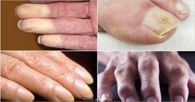 Health Problems Your Hands and Nails Can Warn You About