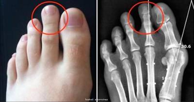 Is Your Second Toe Taller Than Other Toes? Find Out What It Says About Your Personality