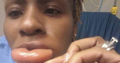 Woman Is Left With One HUGE Lip After Horrific Allergic Reaction To New Lipstick