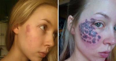 Beauty Blogger Left With Horrific Burns After Laser Treatment For Small Birthmark