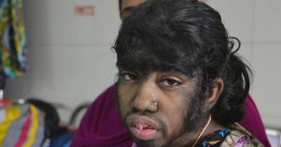 This Girl with &lsquo;Werewolf&rsquo; Syndrome Has to Stay Home Like a Recluse to Escape Her Bullies