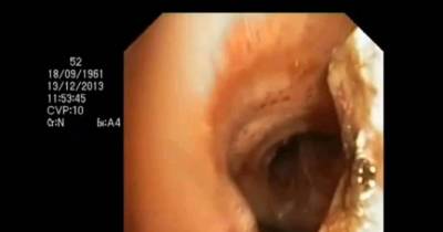 Stomach-Churning Video Shows Thorn Being Surgically Extracted From Person's Lung