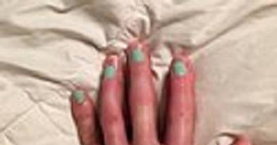 Husband Has A Simple Way To Support His Wife After She Lost Her Pinky