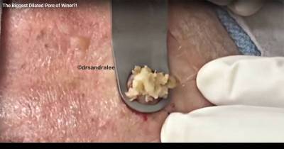 Off His Head! Dr Pimple Popper Pushes Out Pus From A &lsquo;Mother Of A Cyst&rsquo; On A Man&rsquo;s SCALP In Vulgar Video