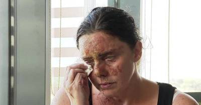 Mother Of 6 Blinded In A Horrific Acid Attack Now Lives On The Streets
