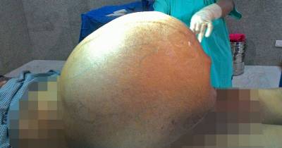 Doctors Remove Mammoth Tumour Weighing 15 Stone That Sat In Woman's Stomach For 5 Years