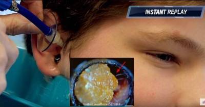 Doctor Extracts Huge Lump Of Ear Wax And It's The Grossest Thing You'll Ever See