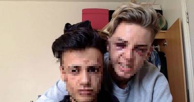 OMG!! Horrific Injuries Man Received After He Was Blinded In 'Homophobic Attack' With Boyfriend
