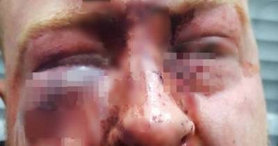 Brutal Injuries Of Man &lsquo;Beaten By Door Staff Outside Nightclub&rsquo;