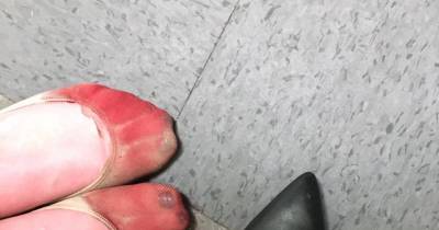 Bloody Heel: Waitress Shares Snap Of Her Feet Covered In Blood After She's Forced To Wear High Heels At Work