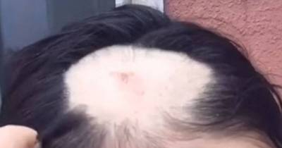 Woman Whose Hair Was Ripped From Her Scalp During A Corn-Eating Challenge Releases Video Of Herself Pulling On Her Remaining Locks To Prove It WAS Real
