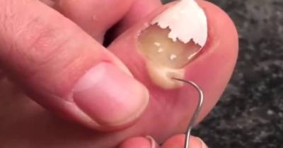 Weird Guy Has A Boil On His Toe And It's Disgusting, But His Reaction To The Puss Is Just Plain Outrageous