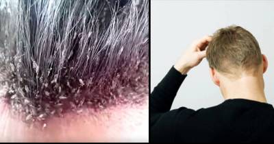 The Most Disgusting Head Lice Infestation You Will Ever See
